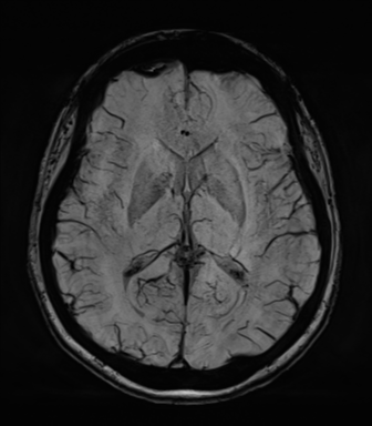 Normal MRI internal auditory canal (Radiopaedia 41613-44525 Axial SWI MIP 42).png