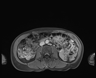 Normal adrenal glands MRI (Radiopaedia 82017-96004 M 54).jpg
