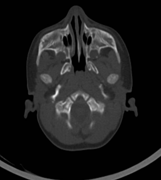 Normal brain CT - 2-month-old (Radiopaedia 53369-59350 Axial bone window 54).jpg
