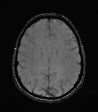 Normal brain MRI (TLE protocol) (Radiopaedia 40748-43405 Axial SWI 58).png