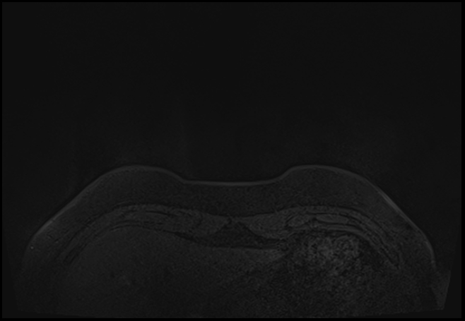 File:Normal breast MRI - dense breasts (Radiopaedia 80454-93850 Axial T1 1).jpg