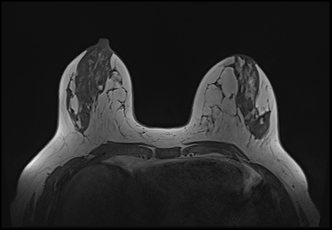 File:Normal breast MRI - dense breasts (Radiopaedia 80454-93850 Axial T1 83).jpg