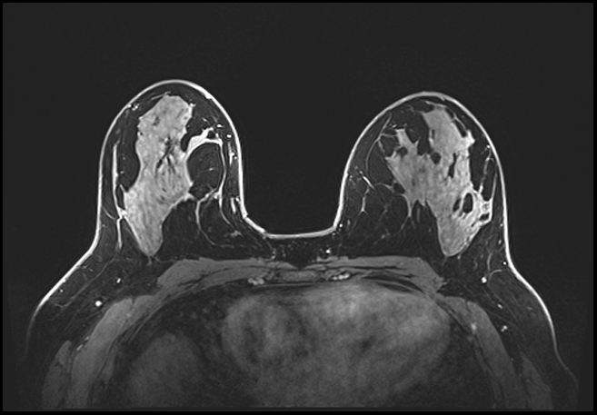 Normal breast MRI - dense breasts (Radiopaedia 80454-93850 C 112).jpg