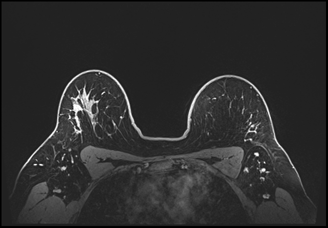 Normal breast MRI - dense breasts (Radiopaedia 80454-93850 C 170).jpg