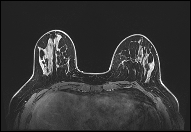 Normal breast MRI - dense breasts (Radiopaedia 80454-93850 C 71).jpg