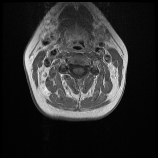 File:Normal cervical and thoracic spine MRI (Radiopaedia 35630-37156 Axial T1 C+ 22).png