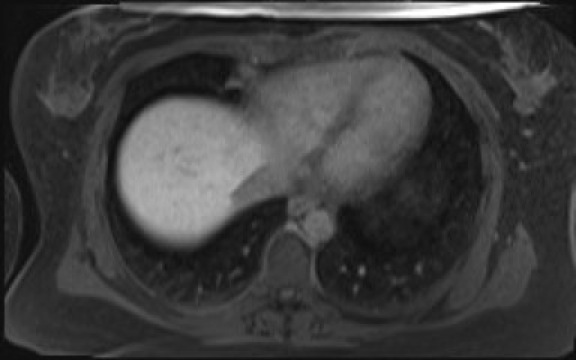 File:Normal hepatobiliary phase liver MRI (Radiopaedia 58968-66230 A 13).jpg