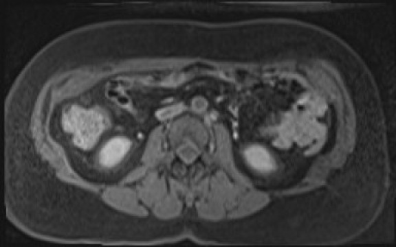 File:Normal hepatobiliary phase liver MRI (Radiopaedia 58968-66230 A 78).jpg