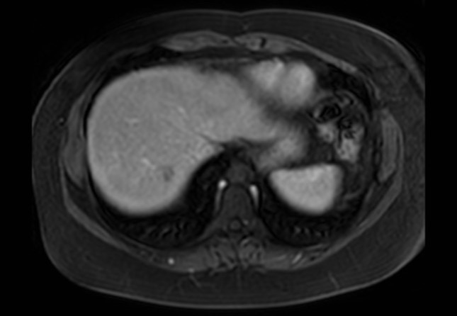 Normal liver MRI with Gadolinium (Radiopaedia 58913-66163 J 65).jpg