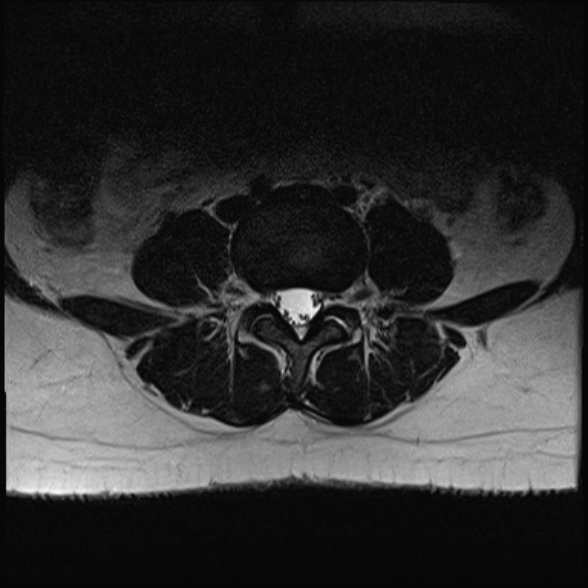 File:Normal lumbar spine MRI- 3 T (Radiopaedia 53280-59250 Axial T2 18).jpg
