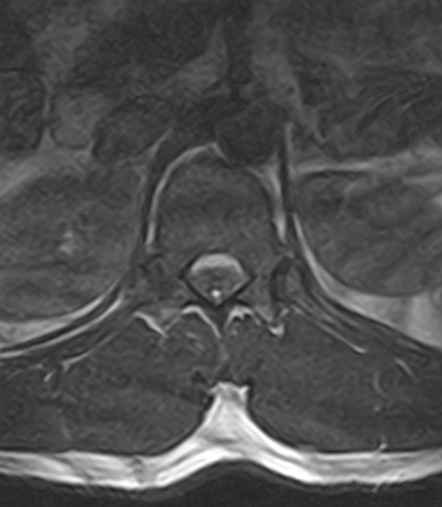 Normal lumbar spine MRI - low-field MRI scanner (Radiopaedia 40976-43699 Axial T2 12).jpg