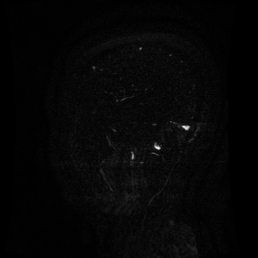 Normal noncontrast MR venography (Radiopaedia 87578-103957 A 141).jpg