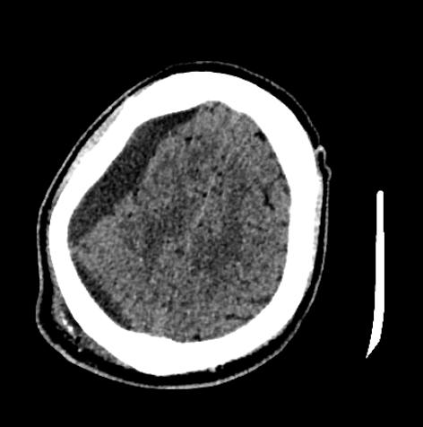 Normal pressure hydrocephalus (Radiopaedia 73685-84479 Axial non-contrast 64).jpg