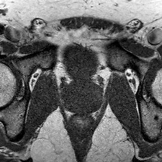 File:Normal prostate (MRI) (Radiopaedia 29986-30535 Axial T1 8).jpg