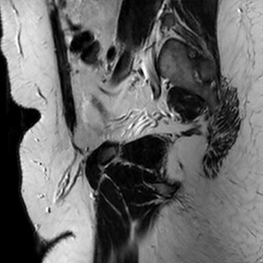File:Normal prostate (MRI) (Radiopaedia 29986-30535 Sagittal T2 20).jpg