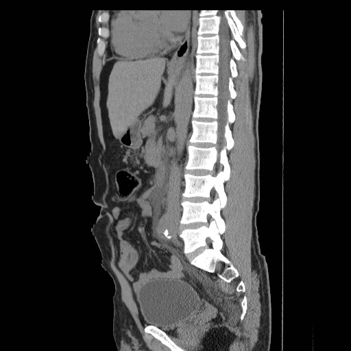 File:Obstructed kidney with perinephric urinoma (Radiopaedia 26889-27066 B 31).jpg