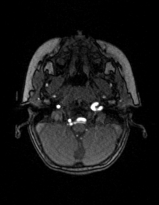 Occipital horn syndrome (Radiopaedia 14255-14129 MRA 22).jpg