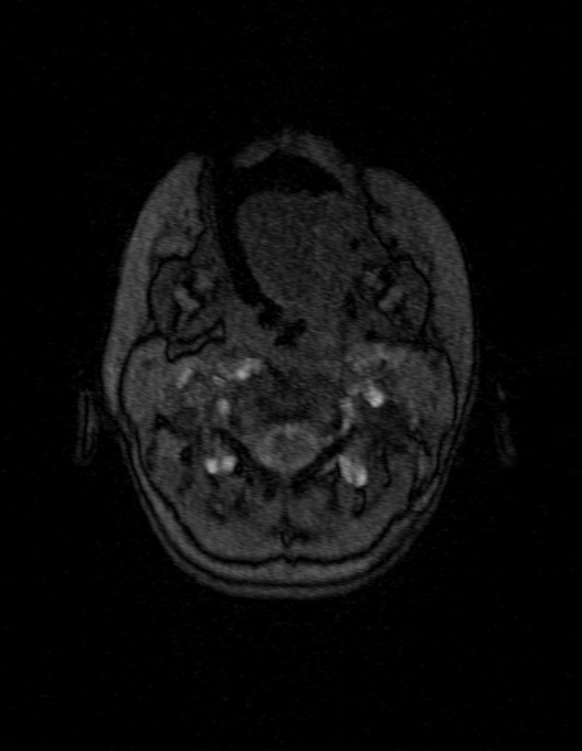 Occipital horn syndrome (Radiopaedia 14255-14129 MRA 3).jpg