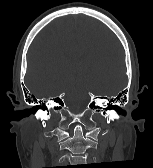 Occipital spur and Currarino type A atlas anomaly (Radiopaedia 87027-103285 Coronal bone window 87).jpg