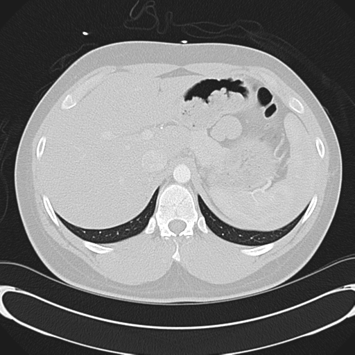 File:'Bovine' aortic arch (Radiopaedia 33554-34637 Axial lung window 62).png