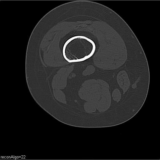File:ACL avulsion fracture (Radiopaedia 33833-34994 Axial bone window 1).jpg