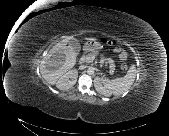 File:Abdominal abscess - pre and post percutaneous drainage (Radiopaedia 60209-67816 Axial 49).png