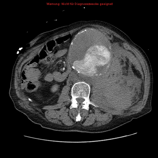 Abdominal aortic aneurysm- extremely large, ruptured (Radiopaedia 19882-19921 Axial C+ arterial phase 35).jpg
