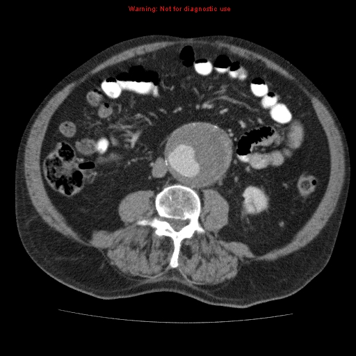 Abdominal aortic aneurysm (Radiopaedia 10122-10660 Axial C+ portal venous phase 44).jpg