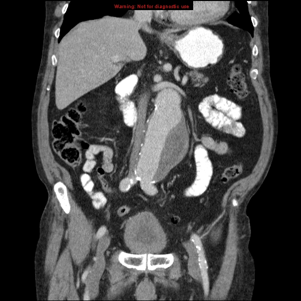 File:Abdominal aortic aneurysm (Radiopaedia 10122-10660 Coronal C+ portal venous phase 18).jpg