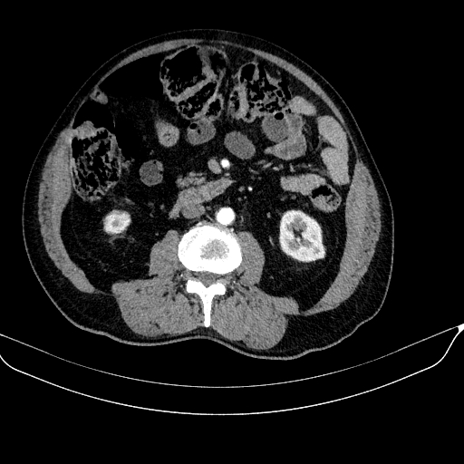 Abdominal aortic aneurysm (Radiopaedia 67117-76452 Axial C+ arterial phase 69).jpg