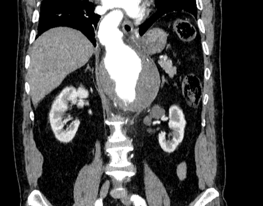 Abdominal aortic aneurysm (Radiopaedia 67117-76452 Coronal C+ arterial phase 58).jpg