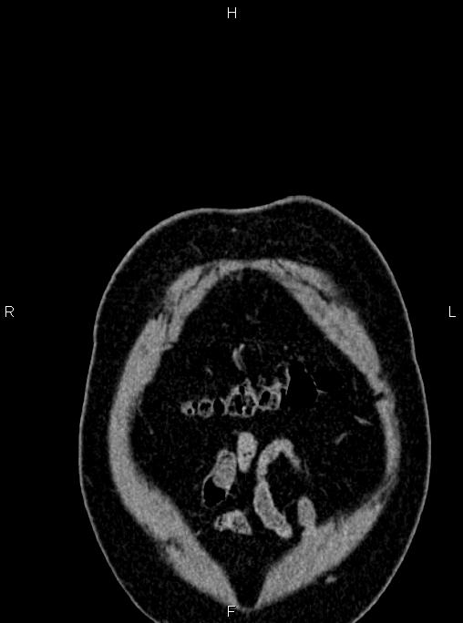 Abdominal aortic aneurysm (Radiopaedia 83094-97462 Coronal renal cortical phase 8).jpg