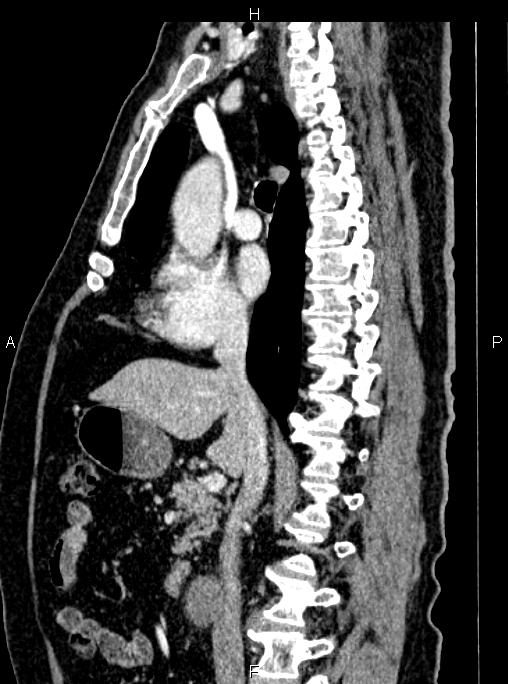 Abdominal aortic aneurysm (Radiopaedia 83094-97462 Sagittal renal cortical phase 58).jpg