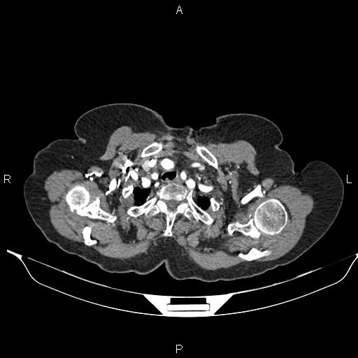File:Abdominal aortic aneurysm (Radiopaedia 85063-100606 Axial C+ arterial phase 6).jpg