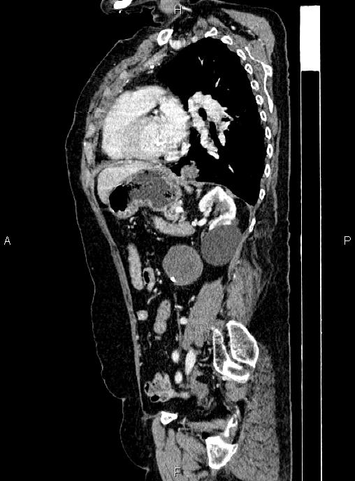 Abdominal aortic aneurysm (Radiopaedia 85063-100606 Sagittal C+ arterial phase 55).jpg
