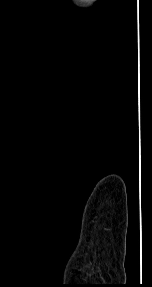Abdominal wall and retroperitoneal tuberculosis (Radiopaedia 88137-104729 Sagittal C+ portal venous phase 151).jpg