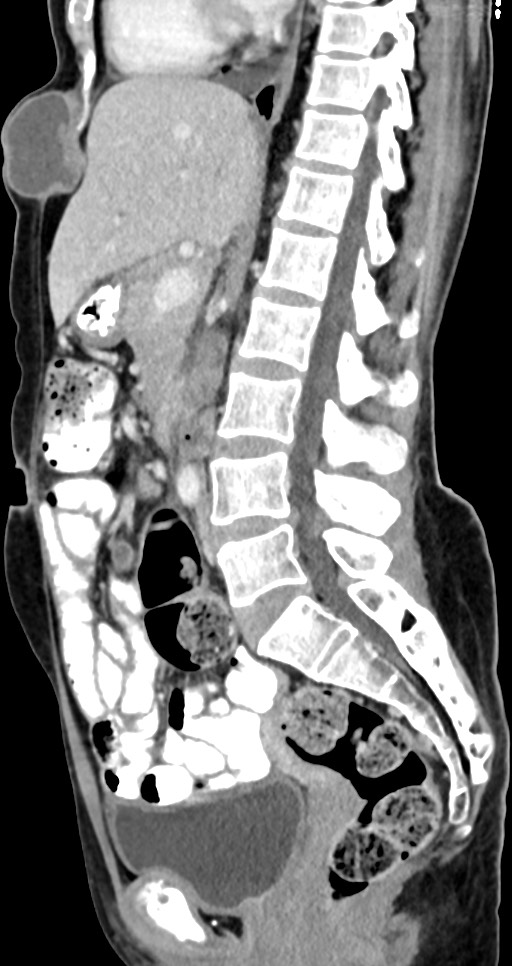 Abdominal wall and retroperitoneal tuberculosis (Radiopaedia 88137-104729 Sagittal C+ portal venous phase 76).jpg