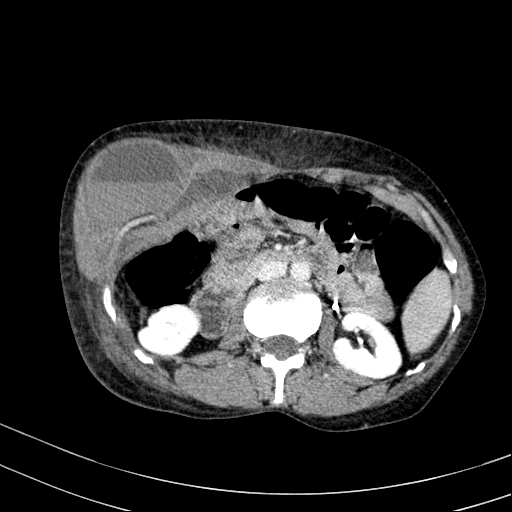 Abdominal wall hematoma with active bleeding (Radiopaedia 83915-99122 Axial contrast-enhanced CT 7).jpg