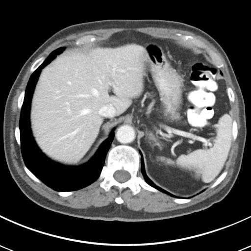 Abdominal wall metastasis from colorectal carcinoma (Radiopaedia 31016-31717 Axial C+ portal venous phase 17).jpg