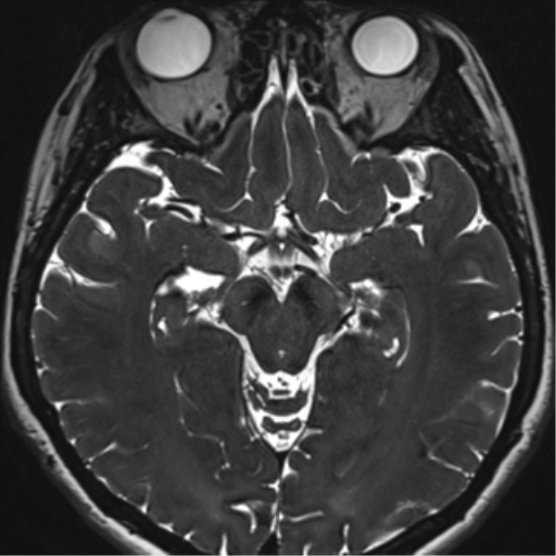 Abducens nerve palsy (Radiopaedia 51069-56648 Axial T2 fat sat 70).png
