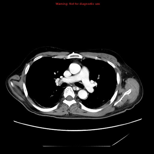 File:Aberrant right subclavian artery (Radiopaedia 9379-10071 Axial C+ arterial phase 28).jpg