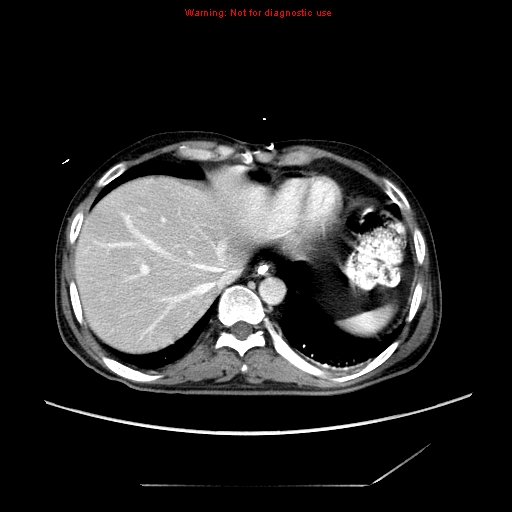 File:Aberrant right subclavian artery (Radiopaedia 9379-10071 Axial C+ arterial phase 55).jpg