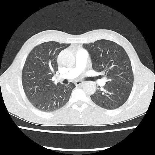 Accessory left horizontal fissure with lingular pneumonia (Radiopaedia 53763-59843 Axial lung window 27).jpg