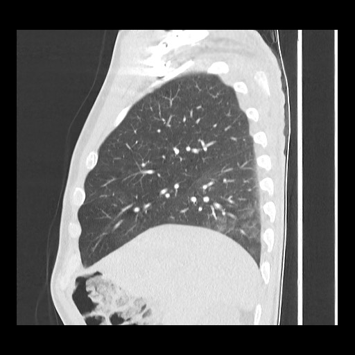Accessory left horizontal fissure with lingular pneumonia (Radiopaedia 53763-59843 Sagittal lung window 21).jpg