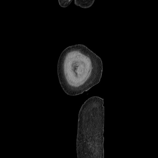 Acinar cell carcinoma of the pancreas (Radiopaedia 75442-86669 Sagittal C+ portal venous phase 189).jpg
