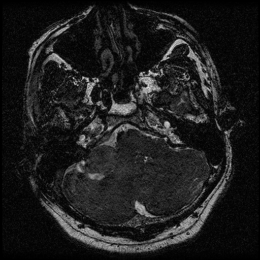 File:Acoustic schwannoma (Radiopaedia 39170-41387 Axial FIESTA 50).png