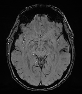 Acoustic schwannoma (Radiopaedia 50846-56358 Axial SWI 43).png