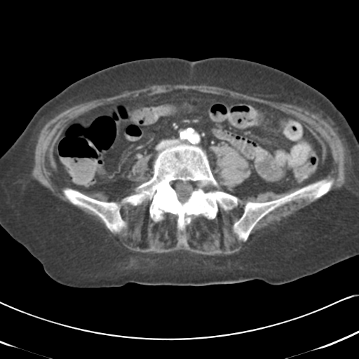 File:Active bleeding from duodenal ulcer with embolization (Radiopaedia 34216-35481 C 39).png