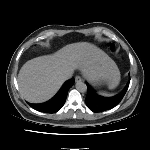 File:Active colonic bleed on CT (Radiopaedia 49765-55025 Axial non-contrast 8).jpg