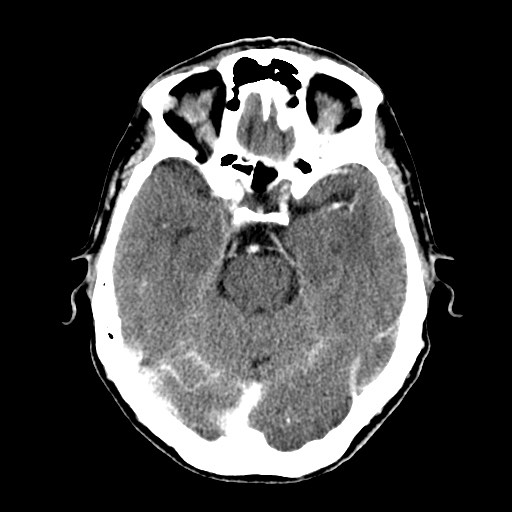 File:Active neurocysticercosis before and after therapy (Radiopaedia 71710-82100 Axial C+ delayed 26).jpg